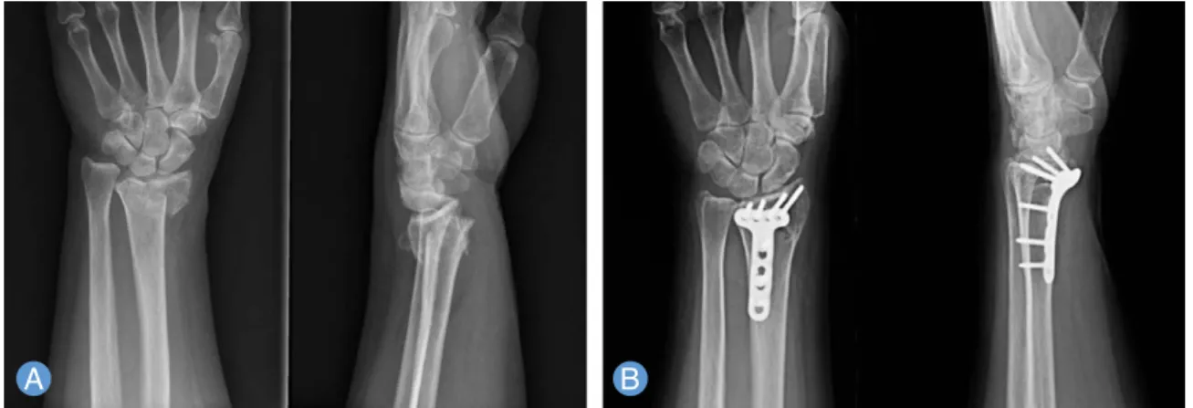 Fig. 3. A 68-year-old female patient was treated with volar locking plate fixation technique for unstable distal radius frac- frac-ture