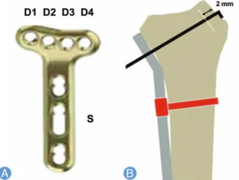Fig. 1. (A) The length of the distal locking screw was measured from radial (D1) to ulnar (D4) and correlated with that of the cortical screw placed in the elongated hole (S)
