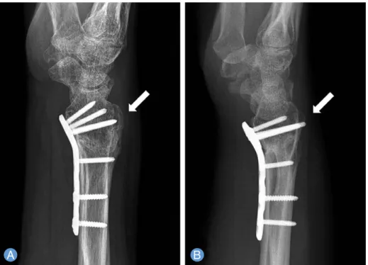 Fig. 2. Relationship between the length of distal locking screws and diaphyseal screws in volar plate fixation of distal radius fractures.