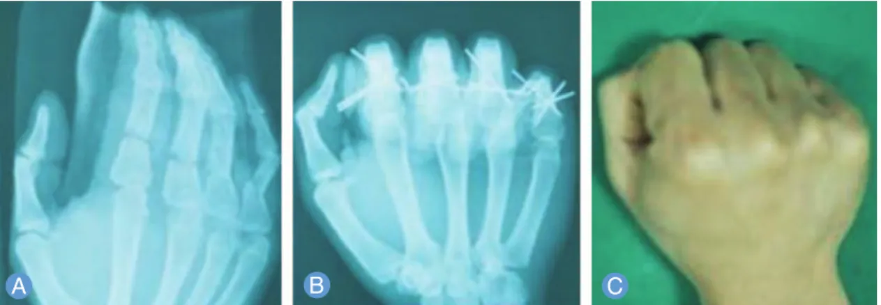 Fig. 4. Multiple transverse fractures with concurrent injures. (A) Multiple transverse fractures of the shaft with the tendon injures in the proximal phalanges accompanied by the dorsal, concave angulation