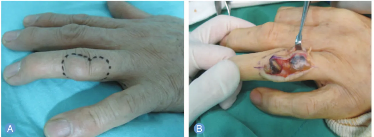 Fig. 1. (A) A nontender, firm mass on the dorsum of the left ring finger is presented