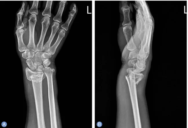 Fig. 1. Initial (A) anteroposterior and (B) lateral radiographic view after injury, showing the distal radius fracture.