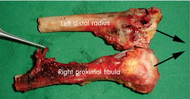 Fig. 2. The articular surface of right distal radius shows volar tilting, but the articular surface of left proximal fibular head shows dorsal tilting.