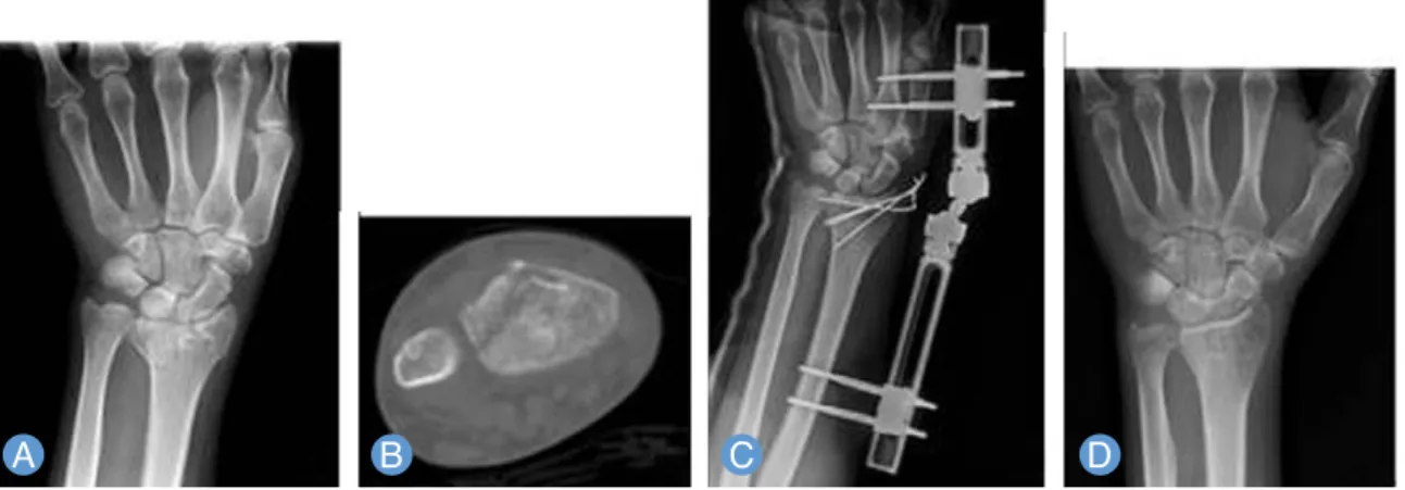 Fig. 2. (A) Radiographs of a 30-year-old male patient show the fracture line extending distal radioulnar joint and a fracture of distal ulna