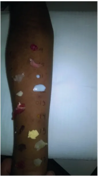 Fig. 2. Picture of skin prick tests results - positive results for hen's egg (white and yolk) and raw meat (cow, pork,  turkey, and rabbit); negative results for cooked meat, cow's milk, and codfish.