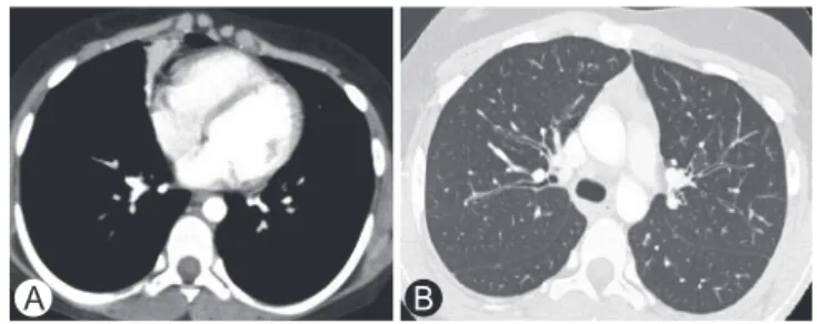 Fig. 2. (A) High resolution computed tomography (HRCT) (mediastinal  window) of the thorax showing middle lobe syndrome