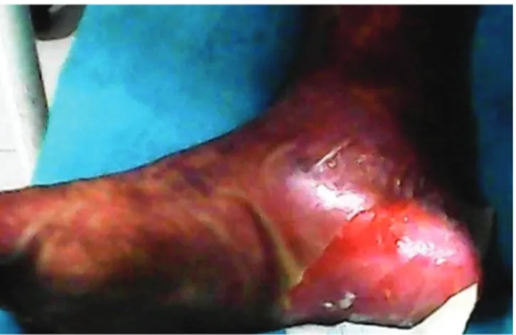 Fig. 2. Large confluent areas of full detachment of epidermis over heels.