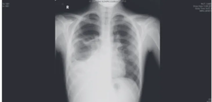 Fig. 1. Chest x-ray of the patient at admission.