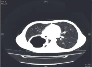 Fig. 2. The appearance of ruptured cyst hydatid in high-resolution com- com-puted tomography.