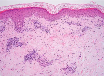 Fig. 2. Pathology of a skin lesion (H&amp;E, ×100). There is dermal edema  and a moderate perivascular inflammatory infiltrate composed of  neutrophils, lymphocytes, and eosinophils, consistent with urticarial  vasculitis.