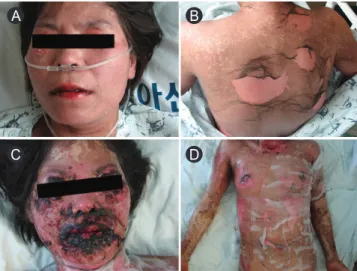 Fig. 1. Bullous mucocutaneous lesions observed on the patient reported  in the first case report