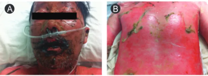 Fig. 2. Bullous mucocutaneous lesions observed on the patient reported  in the second case report