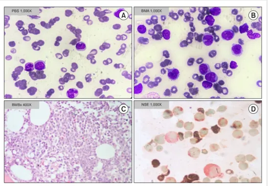 Fig. 1. Peripheral blood and bone  marrow morphology. Peripheral  blood smear showing blasts and  monocytes  (A)