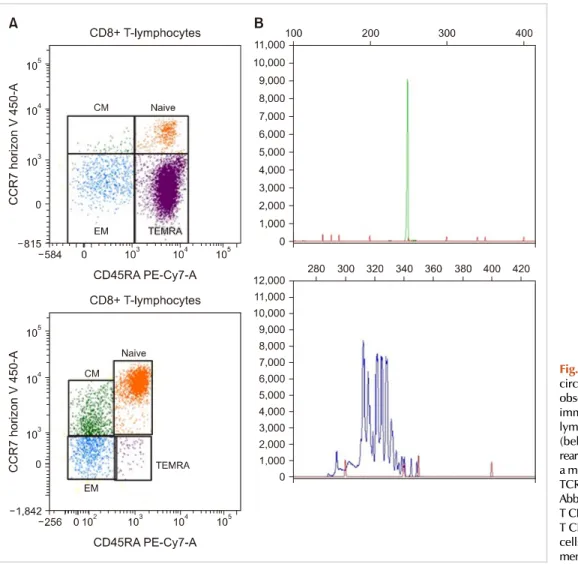 Fig. 1. (A) Immunophenotyping of  circulating lymphocytes at the last  observation (above) compared with  immunophenotyping of circulating  lymphocytes in a healthy donor  (below)