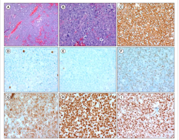 Fig. 1. Brain biopsy showing characteristic findings. (A) ×100 magnification; (B) ×400 magnification