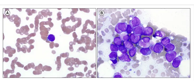 Fig. 1. Microscopic examination of peripheral blood (PB) and bone marrow (BM) (A) PB shows rouleaux formation of red cells and an atypical  promyelocyte