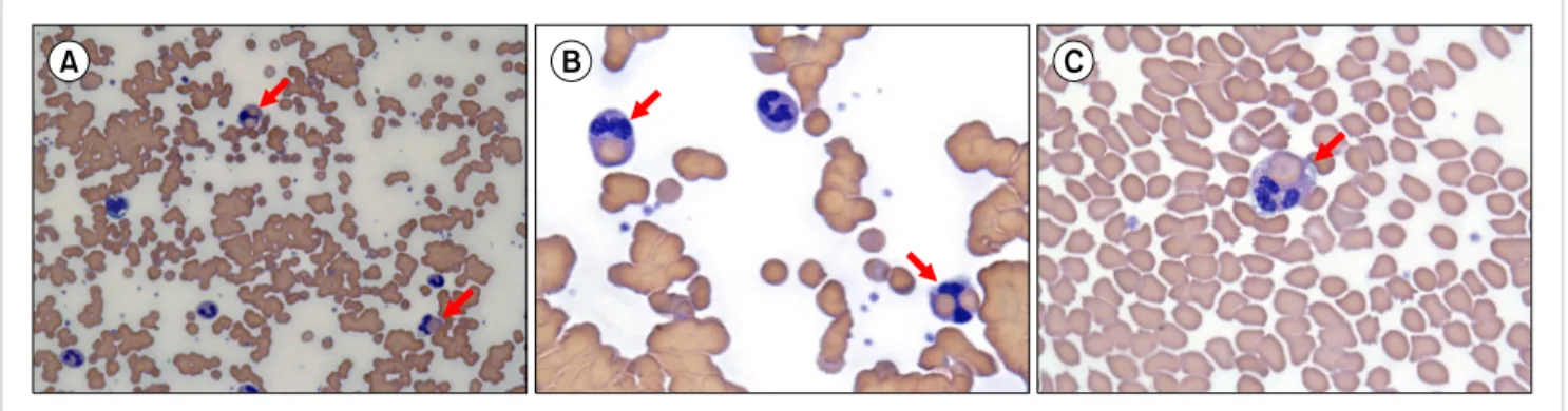 Fig. 1. The peripheral blood smear showed red blood cell agglutination (A, B) and erythrophagocytosis by neutrophils (A, B, C; red arrows).
