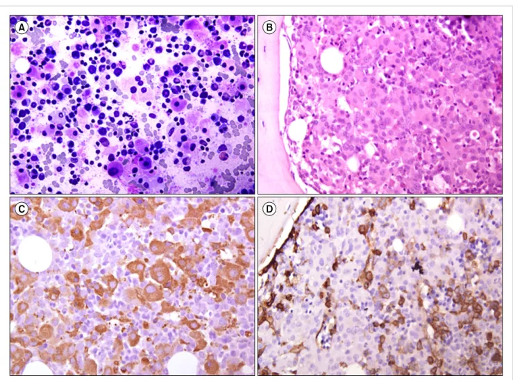 Fig. 2. (A) Bone marrow aspiration showing blasts with abundant granular cytoplasm and small vesicular nuclei (Giemsa, ×400)