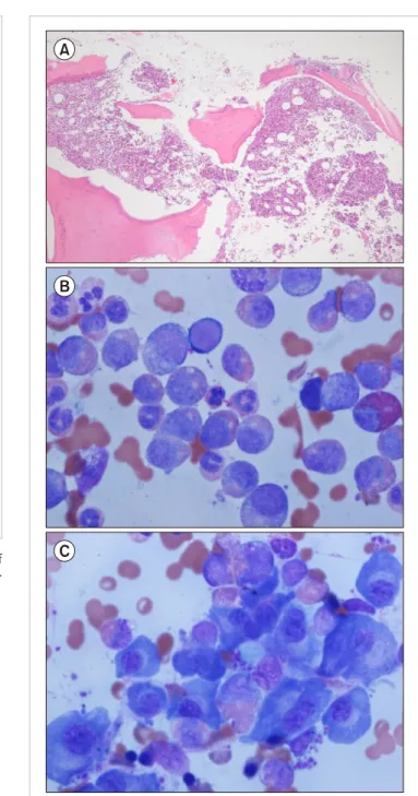 Fig. 1. Biopsy of the right pleural soft-tissue mass. (A) Infiltration of  plasma cells (H&amp;E staining, ×400)