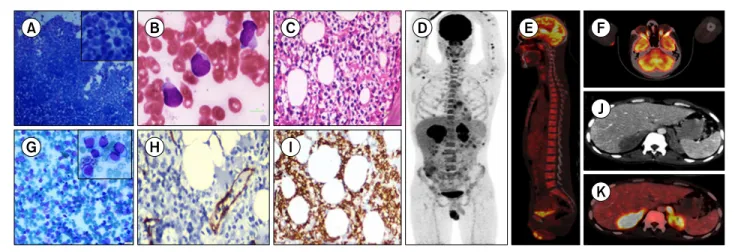 Fig. 1. Microscopic findings, immunohistochemical staining, and whole-body fluorine-18-fluorodeoxyglucose positron emission tomography  /computed tomography ( 18 F-FDG PET/CT) of primary adrenal T-cell lymphoma