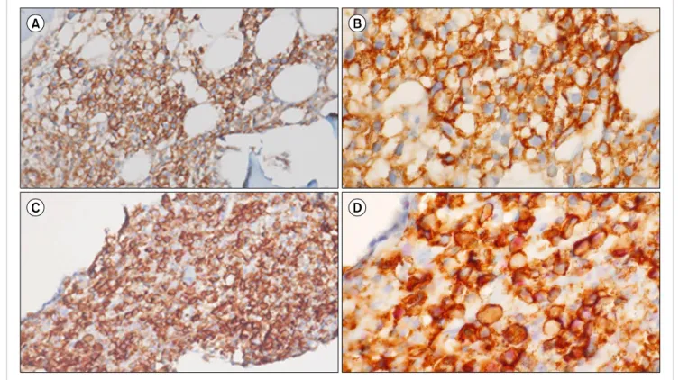 Fig. 1. Dual immunohistochemical staining of bone marrow sections obtained at diagnosis shows (A, B) plasma cells positive for CD138 (brown  cell membranes) and negative for STAT3 expression and (C, D) plasma cells positive for both CD138 and STAT3 (red nu