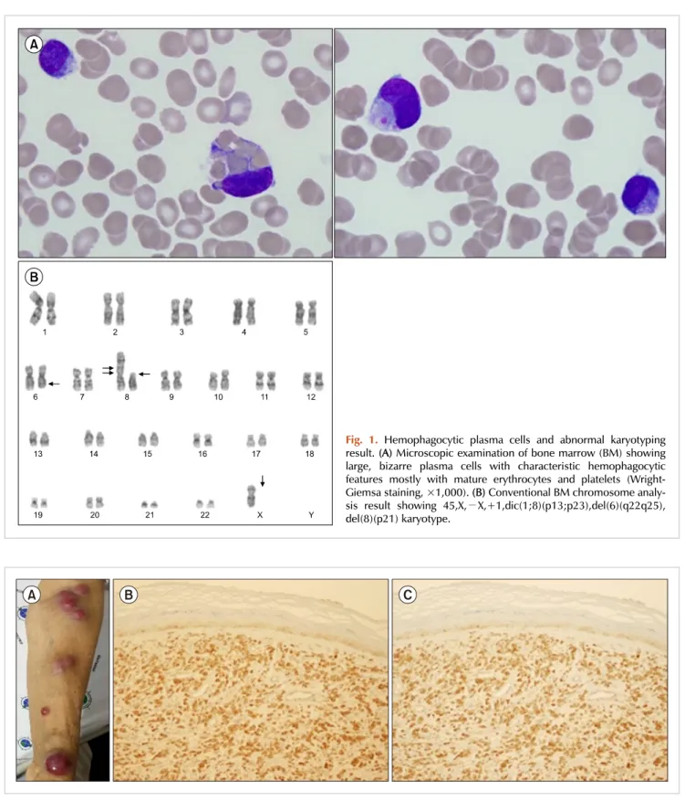 Fig. 2. Multiple skin nodules and their biopsy showing infiltration of plasma cells. Multiple skin nodules in the patient’s extremities (A)
