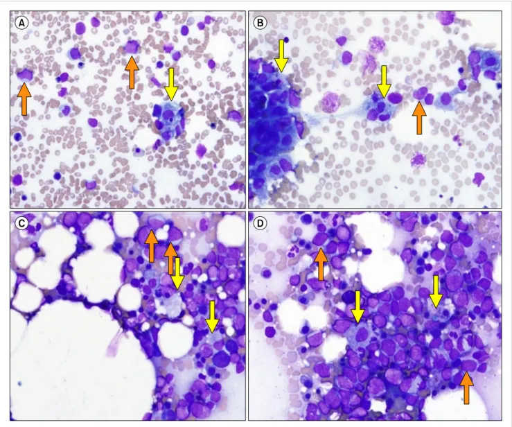 Fig. 1. Bone marrow aspirates (A, B, Wright stain, ×400) and touch print (C, D, Wright stain, ×400)