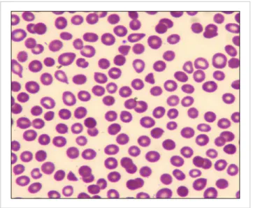 Fig. 1. Peripheral blood smear showing schistocytes and decreased 