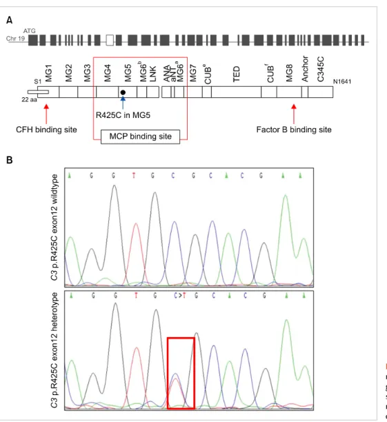 Fig. 1. Restriction fragment length polymorphism analysis of our  patient with heterozygote c.1273C＞T mutation in C3 gene showing  250 bp product (solid arrow)