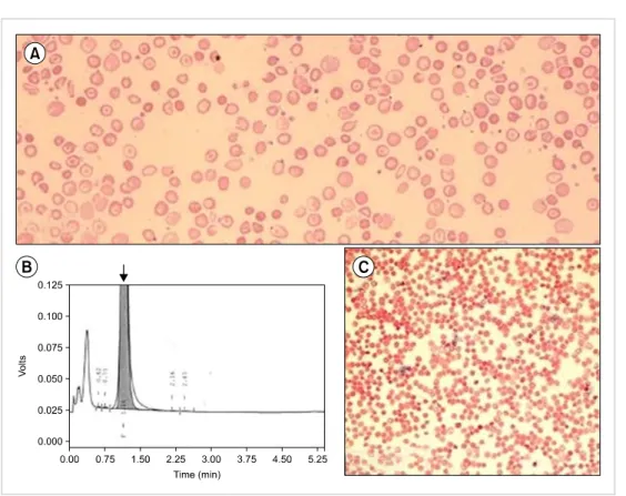 Fig. 1. (A) Peripheral blood smear  of the patient with  anisopoikilo-cytosis and target cells