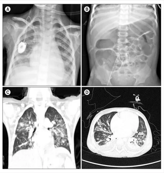Fig. 1. The patient developed fever, dyspnea, and abdominal  disten-sion on day 28 of induction