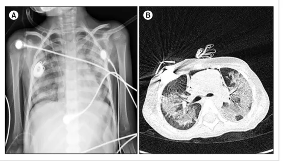 Fig. 2. Sigmoidoscopy performed on day 40 revealed active bleeding with multiple hemorrhagic ulcers throughout the colon (A)