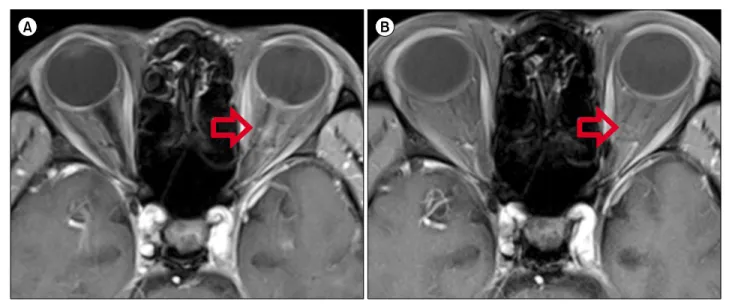Fig. 1. (A) Gadolinium-enhanced, T1-weighted magnetic resonance imaging shows mild thickening and enhancement of the left optic nerve