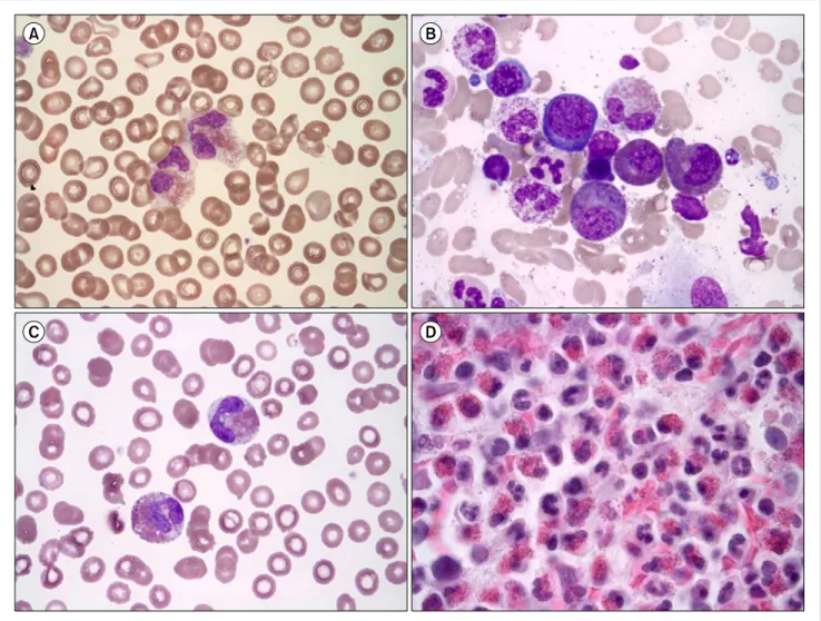 Fig. 1. Peripheral blood (PB) smear and bone marrow (BM) aspirate findings of first case (A, B) and second case (C, D)