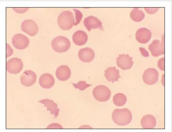 Fig. 2. Trend of improvement in platelet count (×10 9 /L) and creatinine (mg/dl) after starting daily plasma exchange.