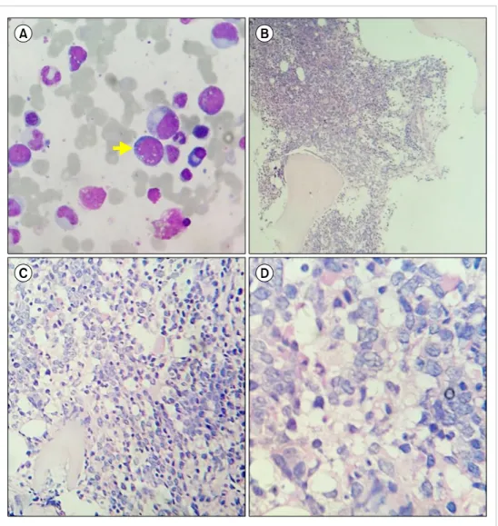 Fig. 3.  (A) Bone marrow aspira- aspira-tion showing few atypical  mono-nuclear cells (arrow) with scanty cytoplasm and vacuolations and  occasional cells with prominent  nucleoli (Leishman stain)