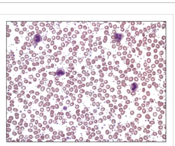 Fig. 1. Thrombocytosis without obvious morphologic abnormalities of  the white blood cells and erythrocytes in peripheral blood smear  (Wright Giemsa stain, ×400).