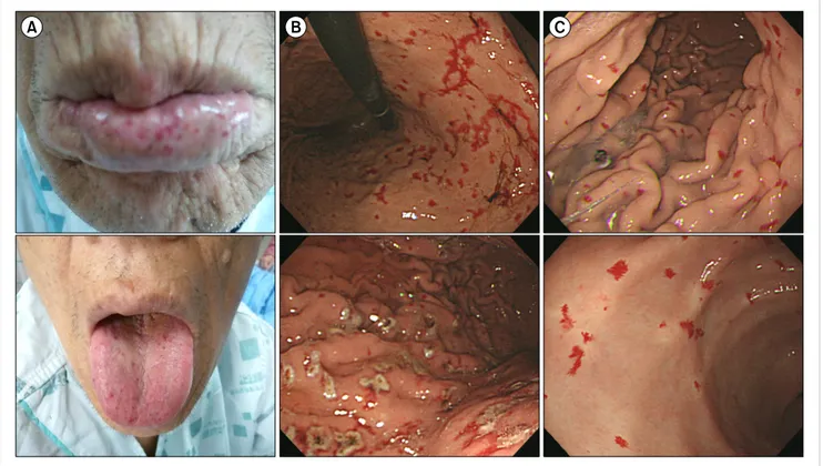 Fig. 2. (A) The lips and tongue showed mucocutaneous telangiectasias. (B) Numerous telangiectasia lesions of the total gastric mucosa with old  blood clots and easy touch bleeding patterns were observed by endoscopic gastroduodenoscopy (EGD)