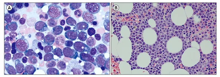 Fig. 1. Bone marrow (BM) aspiration and biopsy findings in the first case. BM aspiration showed the presence of neoplastic cells (27.8%) with oval  to round nuclei, prominent nucleoli, and abundant amount of bluish cytoplasm (A, Wright staining, ×1,000)