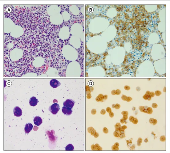 Fig. 2. Findings obtained with  bone marrow biopsy and cytospin  analysis of the cerebrospinal fluid  in the second case