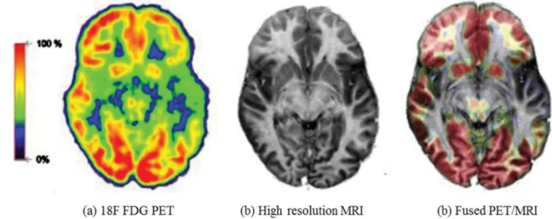 Fig. 10. (Color online) Simultaneous PET/MR study in an epilepsy patient.