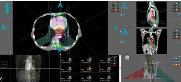 Fig. 2. (Color online) An example case of esophagus cancer patient by 3D-conformal radiation therapy in linear accelerator.