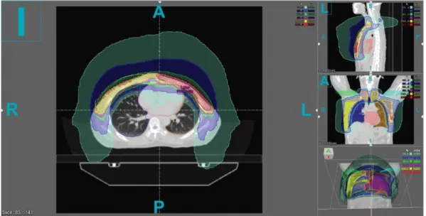 Fig. 4. (Color online) A Digital reconstruction images (DRR) in Intensity modulated radiation therapy using linear accelerator