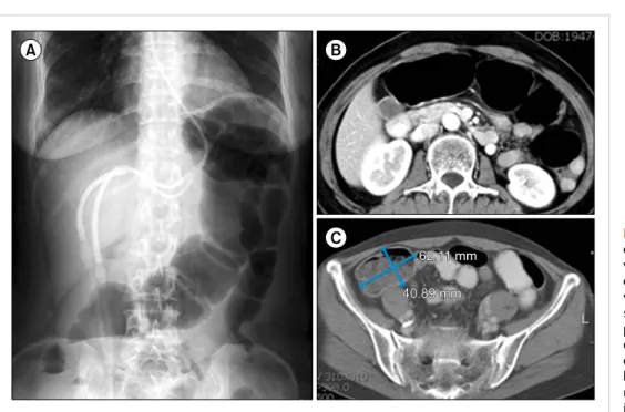 Fig. 1. Plain abdominal radiograph  on day +20 post-transplant  re-veals the presence of a dilated  colon (A)