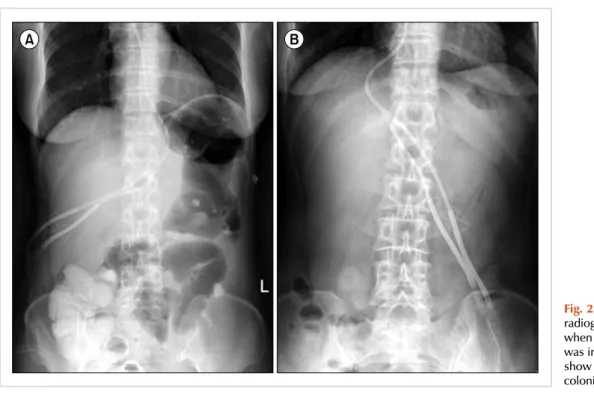 Fig. 2. Follow-up plain abdominal  radiographs obtained on day +24,  when neostigmine administration  was initiated (A), and on day +30  show complete resolution of the  colonic dilatation (B).