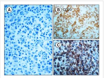 Fig. 1.  (A)  Bone marrow biopsy (Giemsa stain, high magnification)  showing a neoplastic infiltrate composed predominantly of blastic cells  with centroblastic morphology, with minor components composed of  small centrocyte-like cells