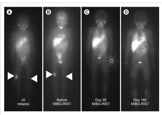 Fig. 1. Representative case. The  patient had  131  I-meta-iodobenzy-lguanidine (MIBG) uptake at  re-lapse after tandem  HDCT/auto-SCT (A) (arrow head)