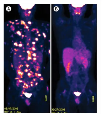 Fig. 2. Whole body PET-CT (A) At the second relapse, multiple nodules  with high signal intensities were noted in multiple subcutaneous and  muscular areas