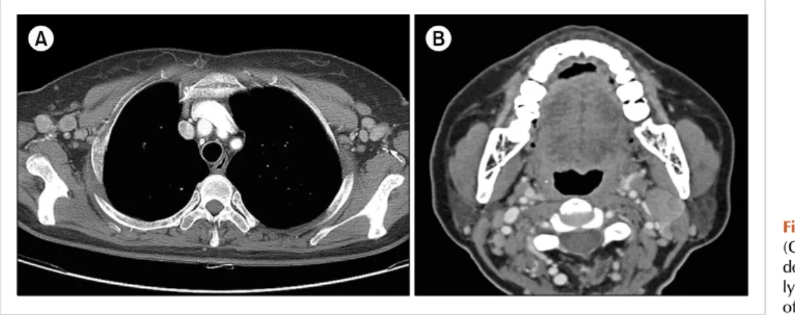 Fig. 2. Computed tomography  (CT) scans show multiple  lympha-denopathies in both axillae (A) and lymphadenopathies on both sides  of the neck (B).