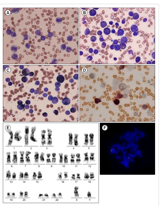 Fig. 1. Morphologic and cytoge- cytoge-netic study. (A) Peripheral blood  smear and (B) bone marrow  as-pirates show myeloblasts,  imma-ture monocyte precursors, and  abnormal eosinophils